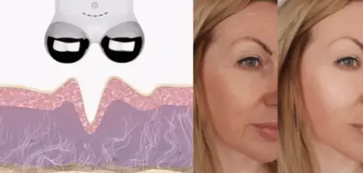 gif of Derma Micro Tone in use and before and after images